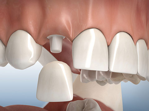 3D-Implantatplanung mit Navigation